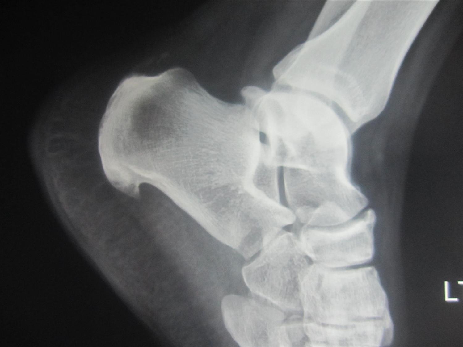 Achilles Tendonitis Foot & Ankle Orthobullets